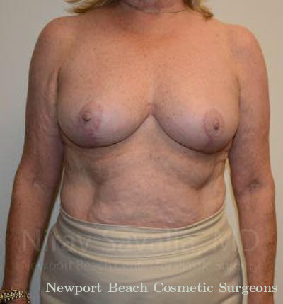 Mastectomy Reconstruction Revision Before & After Gallery - Patient 1655496 - After