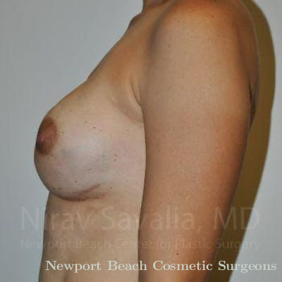 Oncoplastic Reconstruction Before & After Gallery - Patient 1655492 - After