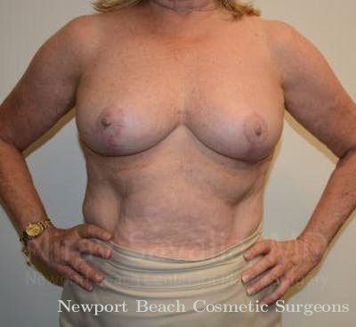 Breast Lift with Implants Before & After Gallery - Patient 1655496 - After