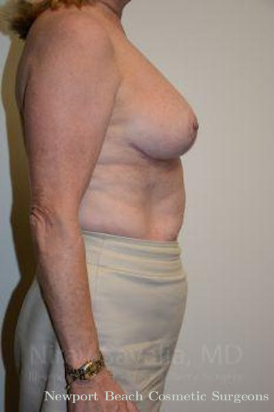 Breast Implant Revision Before & After Gallery - Patient 1655496 - After
