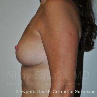 Breast Augmentation Before & After Gallery - Patient 1655493 - After
