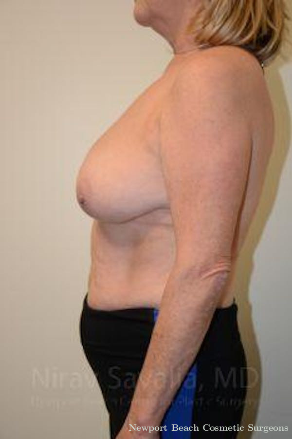 Breast Explantation En Bloc Capsulectomy Before & After Gallery - Patient 1655496 - Before