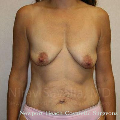 Breast Lift with Implants Before & After Gallery - Patient 1655497 - Before