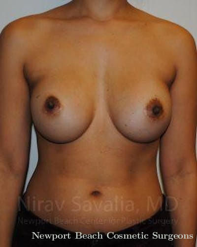 Mastectomy Reconstruction Before & After Gallery - Patient 1655498 - Before