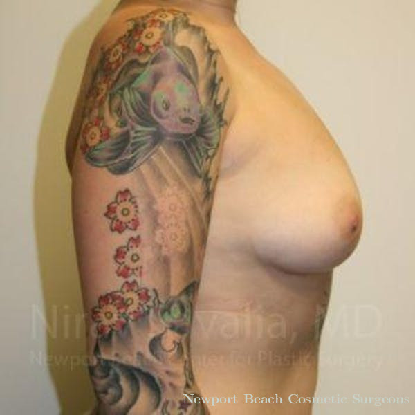 Breast Explantation En Bloc Capsulectomy Before & After Gallery - Patient 1655500 - Before