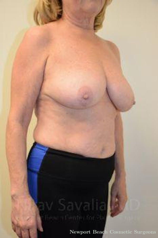 Arm Lift Before & After Gallery - Patient 1655496 - Before