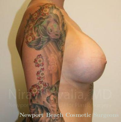 Breast Reduction Before & After Gallery - Patient 1655500 - After