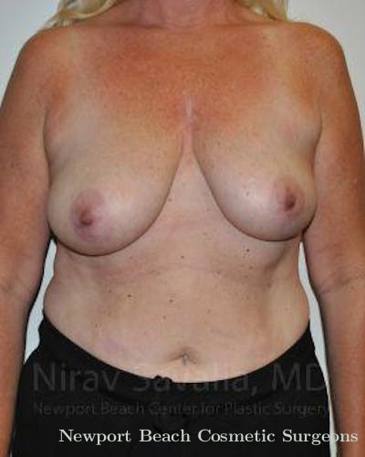 Breast Explantation En Bloc Capsulectomy Before & After Gallery - Patient 1655499 - Before