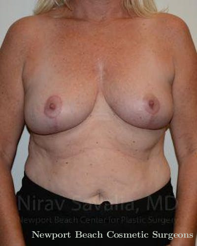 Oncoplastic Reconstruction Before & After Gallery - Patient 1655499 - After
