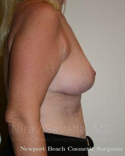 Facelift Before & After Gallery - Patient 1655499 - After