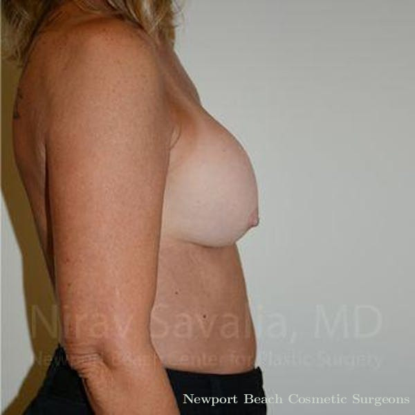 Breast Reduction Before & After Gallery - Patient 1655503 - Before