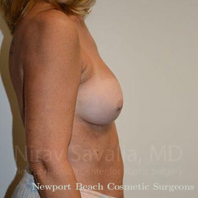Chin Implants Before & After Gallery - Patient 1655503 - After