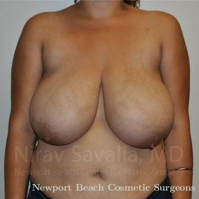 Mastectomy Reconstruction Revision Before & After Gallery - Patient 1655504 - Before