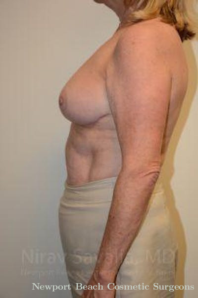 Mastectomy Reconstruction Revision Before & After Gallery - Patient 1655501 - After