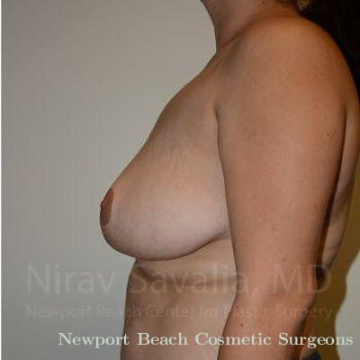Breast Reduction Before & After Gallery - Patient 1655504 - After