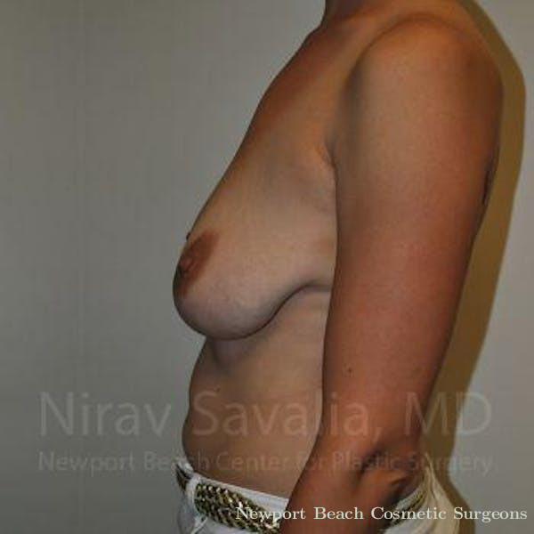 Breast Implant Revision Before & After Gallery - Patient 1655502 - Before