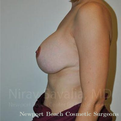 Breast Explantation En Bloc Capsulectomy Before & After Gallery - Patient 1655502 - After