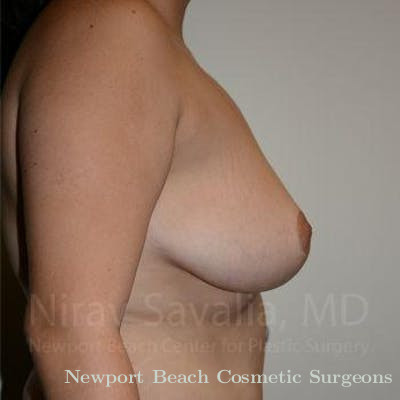 Mastectomy Reconstruction Revision Before & After Gallery - Patient 1655504 - After
