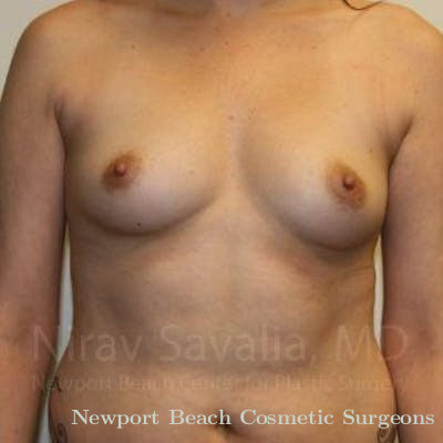 Breast Explantation En Bloc Capsulectomy Before & After Gallery - Patient 1655506 - Before