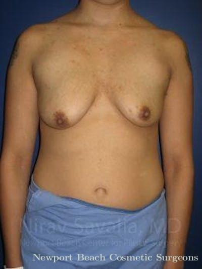 Mastectomy Reconstruction Revision Before & After Gallery - Patient 1655508 - Before