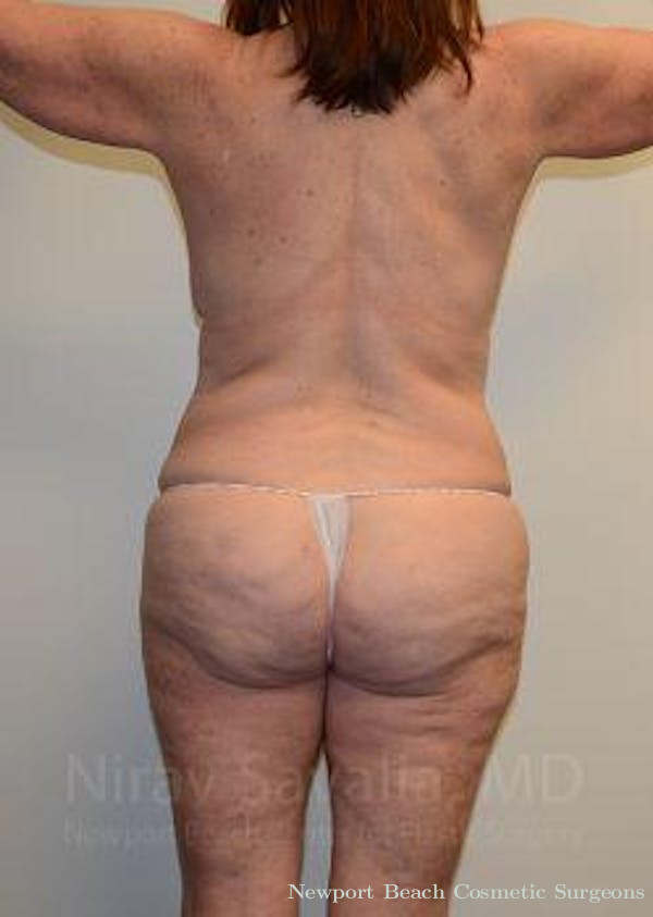 Mastectomy Reconstruction Before & After Gallery - Patient 1655509 - Before
