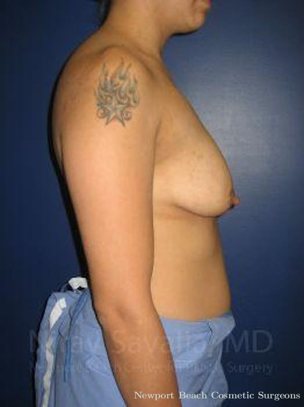 Body Contouring after Weight Loss Before & After Gallery - Patient 1655508 - Before