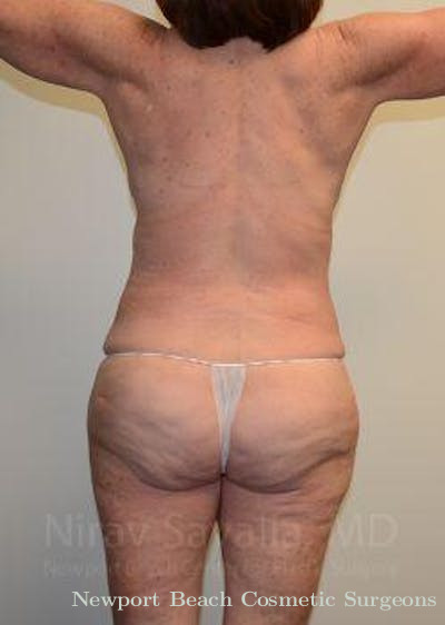 Fat Grafting to Face Before & After Gallery - Patient 1655509 - After