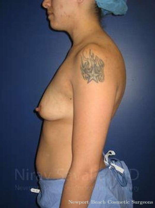 Breast Reduction Before & After Gallery - Patient 1655508 - Before