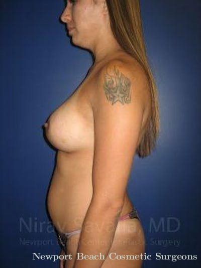 Liposuction Before & After Gallery - Patient 1655508 - After