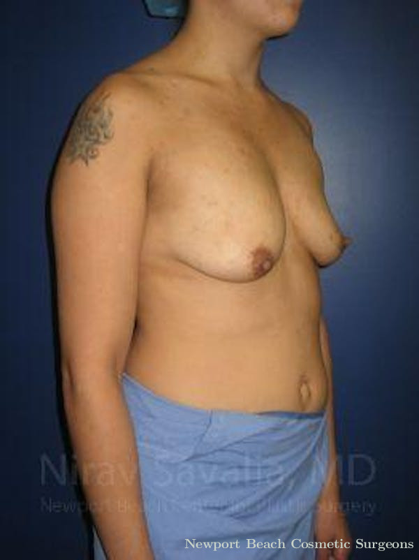 Breast Lift with Implants Before & After Gallery - Patient 1655508 - Before