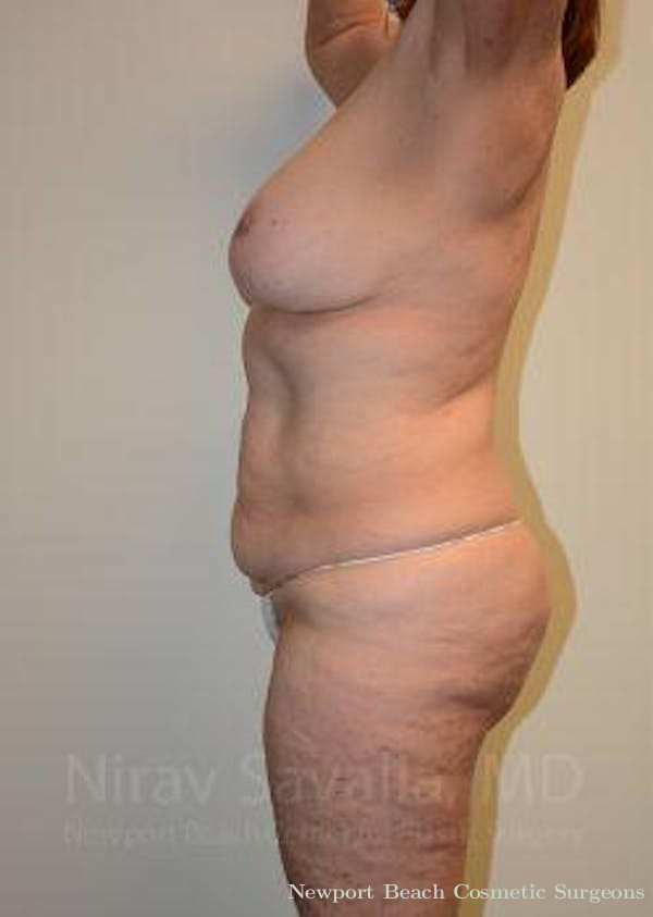 Mastectomy Reconstruction Revision Before & After Gallery - Patient 1655509 - Before
