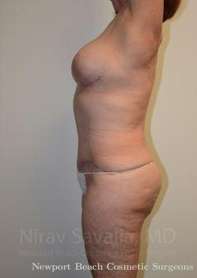 Mastectomy Reconstruction Revision Before & After Gallery - Patient 1655509 - After