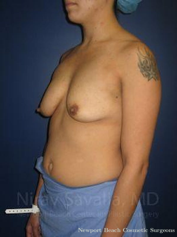 Breast Explantation En Bloc Capsulectomy Before & After Gallery - Patient 1655508 - Before