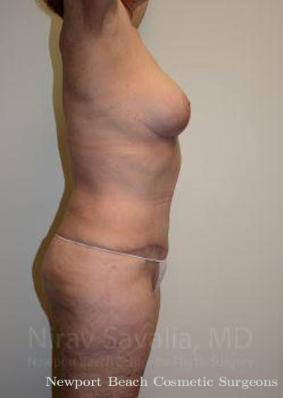 Breast Explantation En Bloc Capsulectomy Before & After Gallery - Patient 1655509 - After