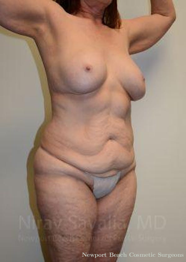 Breast Lift without Implants Before & After Gallery - Patient 1655509 - Before
