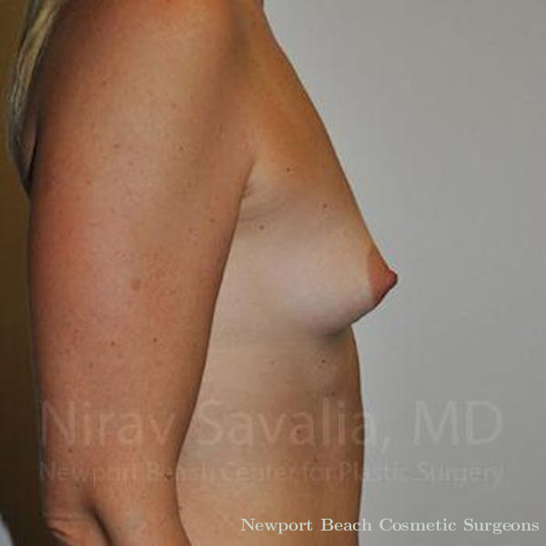 Mastectomy Reconstruction Revision Before & After Gallery - Patient 1655512 - Before