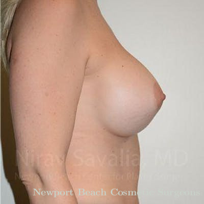 Male Breast Reduction Before & After Gallery - Patient 1655512 - After