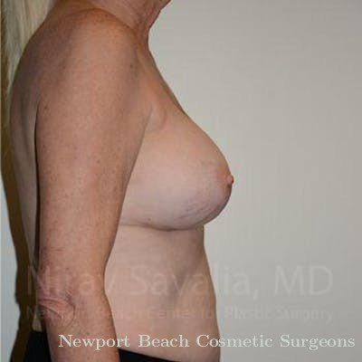 Arm Lift Before & After Gallery - Patient 1655513 - After