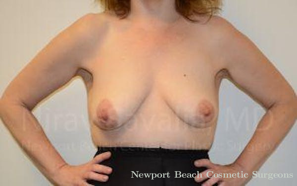 Mastectomy Reconstruction Revision Before & After Gallery - Patient 1655514 - Before