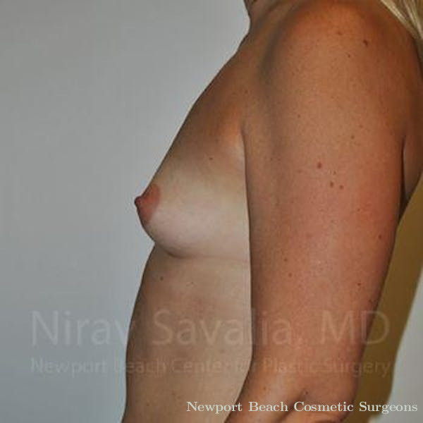 Breast Lift with Implants Before & After Gallery - Patient 1655512 - Before