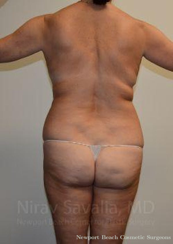 Oncoplastic Reconstruction Before & After Gallery - Patient 1655515 - Before