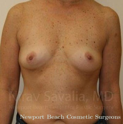 Breast Reduction Before & After Gallery - Patient 1655519 - Before