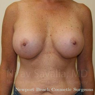 Breast Explantation En Bloc Capsulectomy Before & After Gallery - Patient 1655519 - After