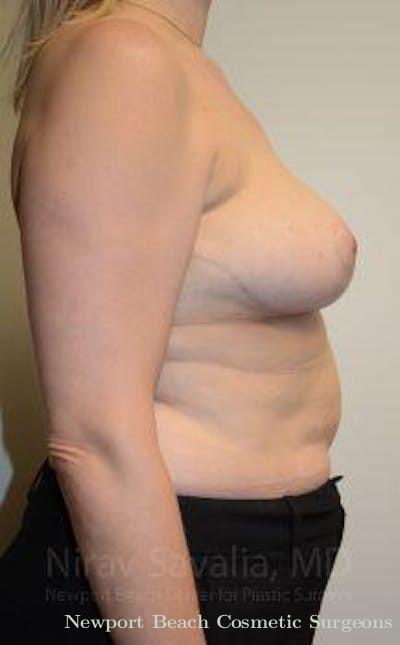 Mastectomy Reconstruction Before & After Gallery - Patient 1655516 - After