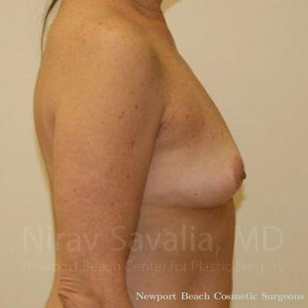 Mastectomy Reconstruction Revision Before & After Gallery - Patient 1655519 - Before