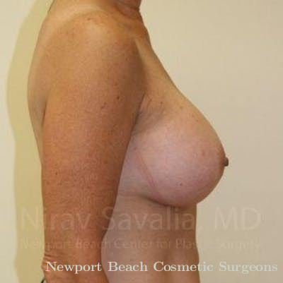 Mastectomy Reconstruction Revision Before & After Gallery - Patient 1655519 - After