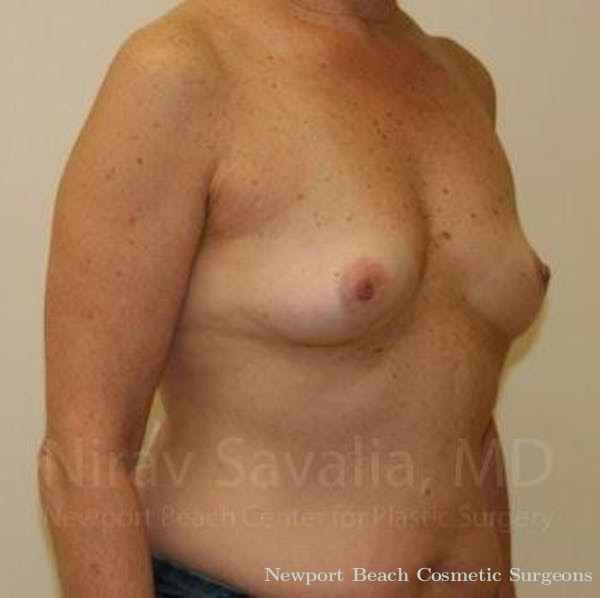 Mastectomy Reconstruction Before & After Gallery - Patient 1655519 - Before