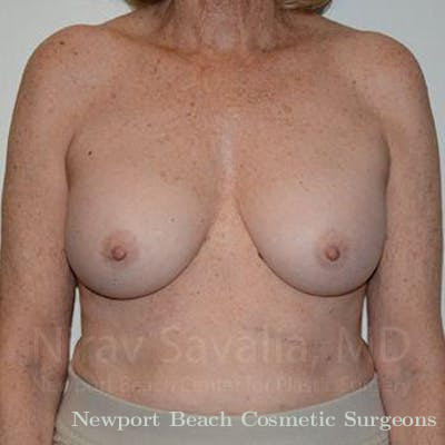 Mastectomy Reconstruction Revision Before & After Gallery - Patient 1655520 - After