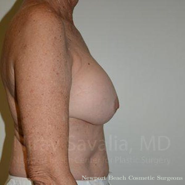 Facelift Before & After Gallery - Patient 1655520 - Before