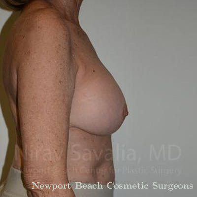 Mastectomy Reconstruction Before & After Gallery - Patient 1655520 - After
